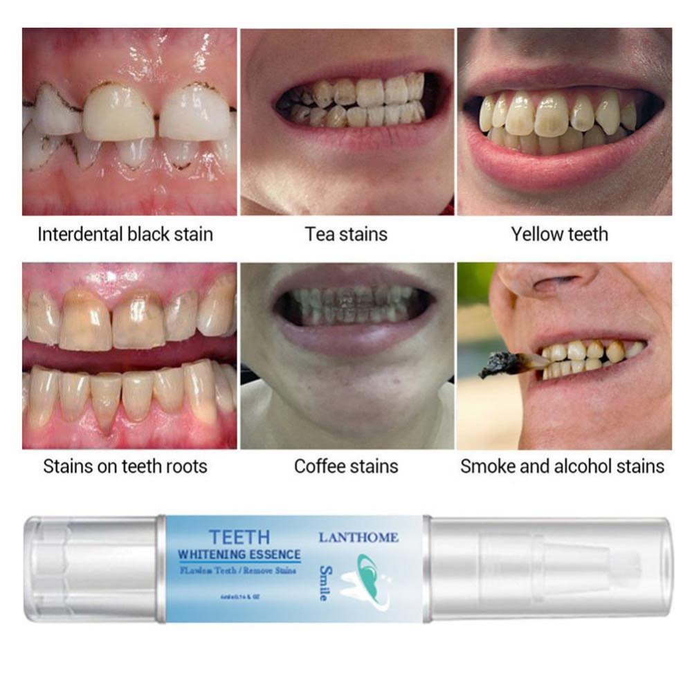 Teeth Whitening Pen Tooth Diamond Gel Bleach Dental Plaque Shop kitchen home
